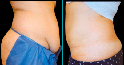 Wie wird eine Abdominoplastik durchgeführt?