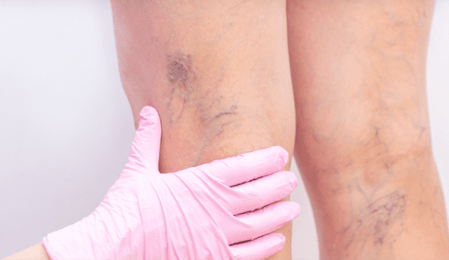 Besenreiser an den Beinen: Ein häufiges ästhetisches Anliegen