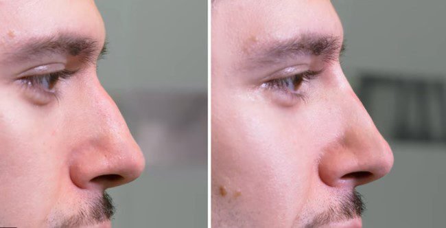 Nasenkorrektur ohne Operation