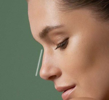 Ohne OP Nasenkorrektur