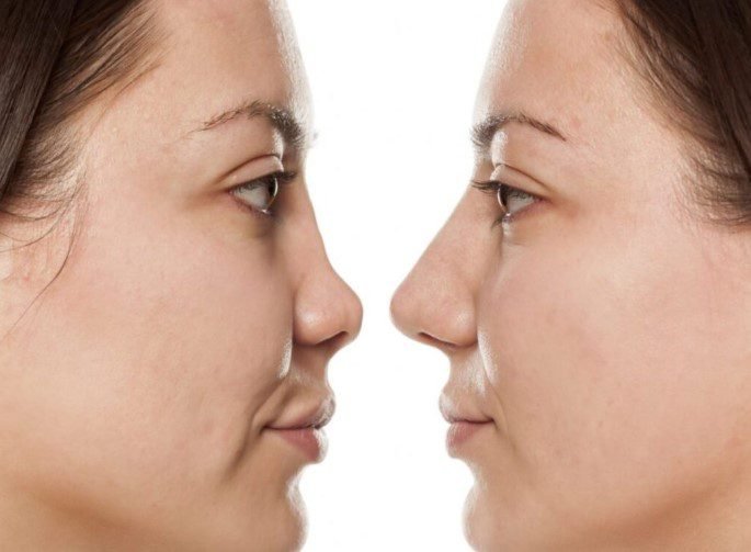 nasenkorrektur risiko
