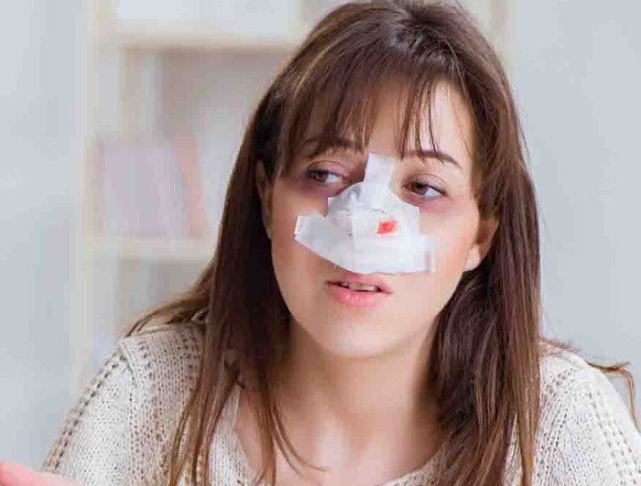 nach nasenkorrektur immer noch höcker
