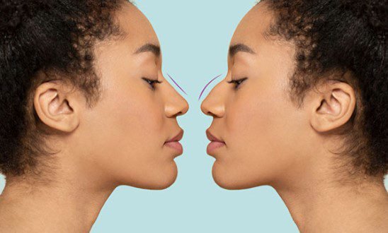 preise für nasenkorrektur
