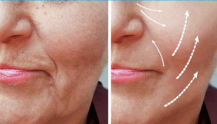 Welche Facelifting Methode ist die richtige?