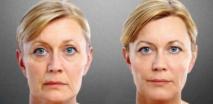 Wie läuft ein SMAS Facelifting ab?