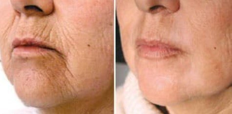 Wie funktioniert ein Laser Facelifting