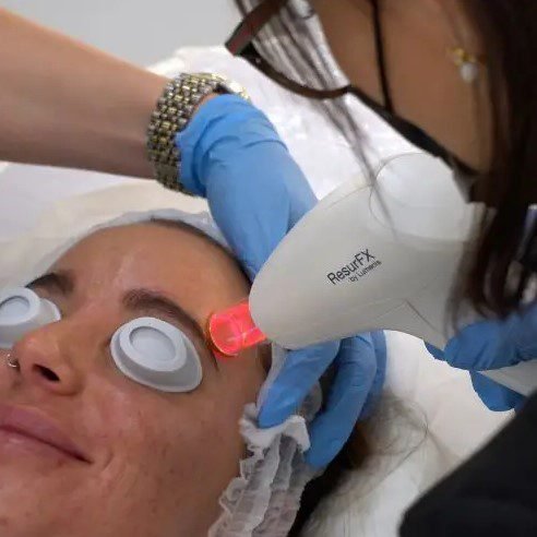 Anwendungsbereiche des Laser Faceliftings