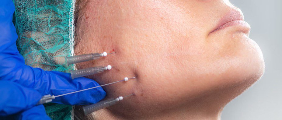 Wie funktioniert das Fadenlifting