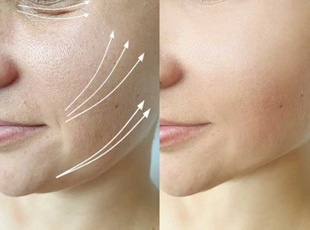 Anwendungsbereiche des Fadenliftings