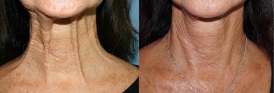 Für wen ist eine Halsstraffung geeignet