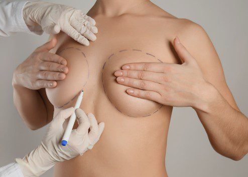 Bruststraffung Kosten & Krankenkasse