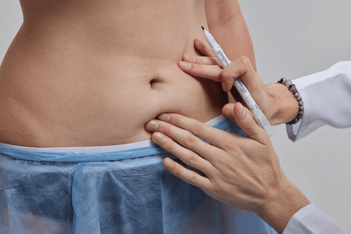 Bauchdeckenstraffung