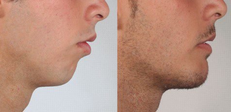 kinnimplantat vorher-nachher
