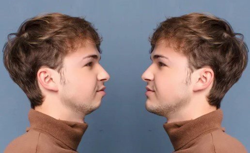 fliehendes kinn op vorher-nachher
