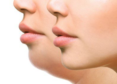 kinnimplantat erfahrungen
