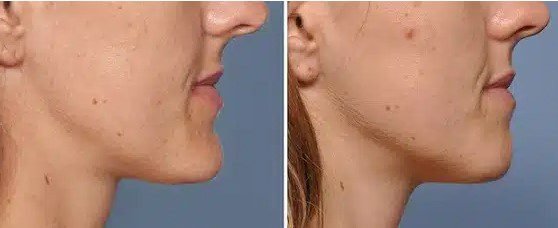 kinnverkleinerung vorher nachher
