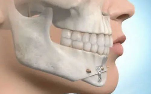 kinn abschleifen erfahrungen
