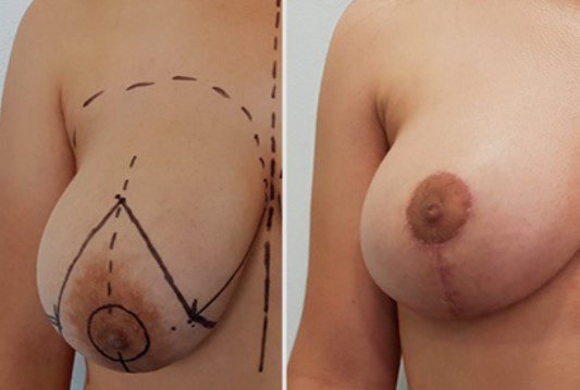 Bruststraffung Narben & Methoden