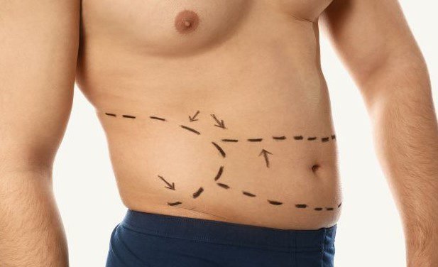Bauchfett loswerden Mann