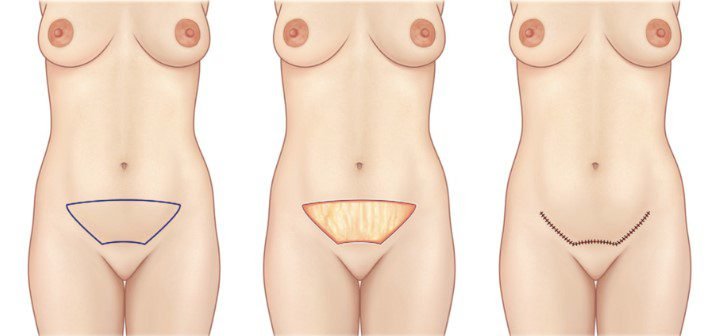 Was ist eine Mini-Bauchdeckenstraffung?