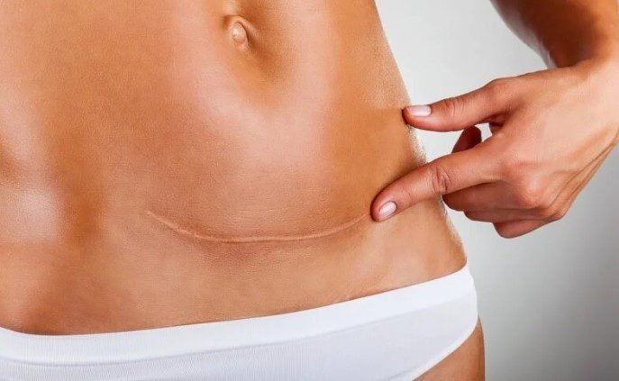 Mini-Bauchdeckenstraffung