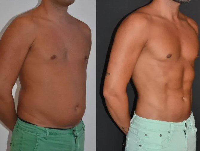 Brustmodellierung beim Mann